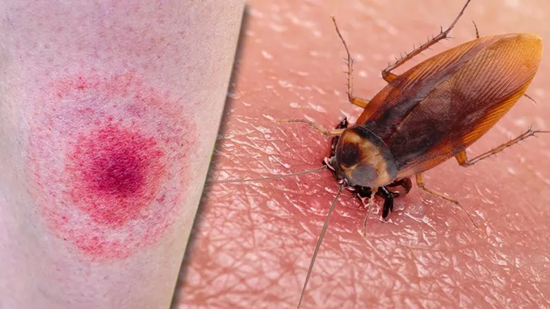 Vết đốt từ gián